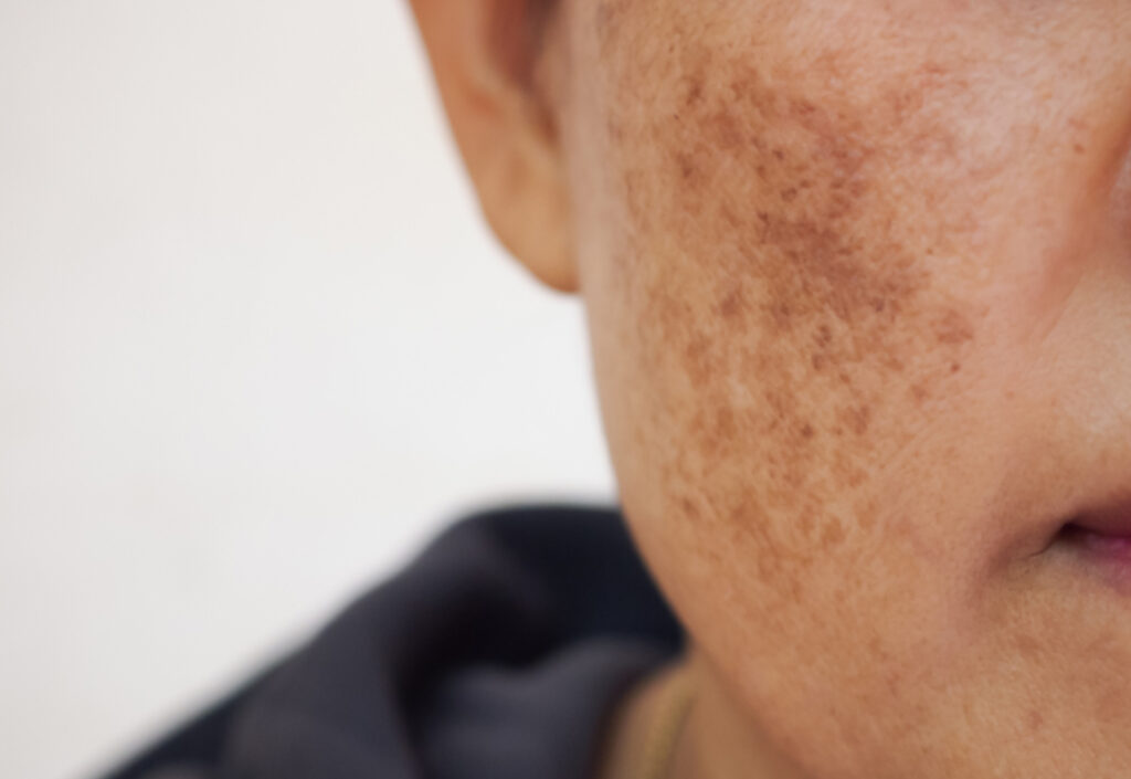 Óleo Essencial Para Melasma